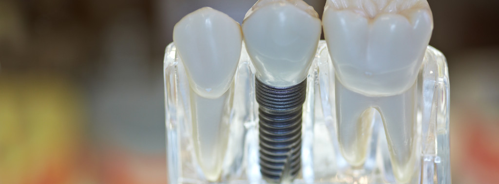 Absolute Dental Vancouver teeth model