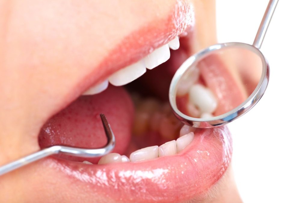 The Truth About Fillings