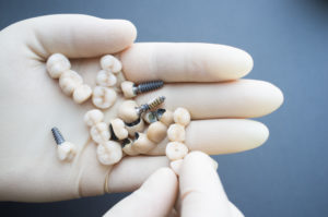 dental implants Vancouver Surrey Richmond